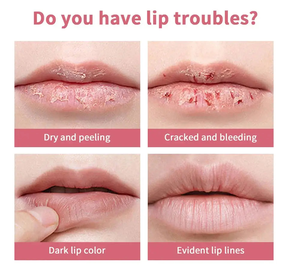 Image showing various lip troubles: dry and peeling, cracked and bleeding, dark lip color, and evident lip lines.